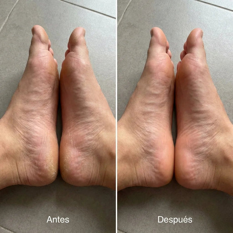 Piel dura del talon antes y despues de dos semanas de uso