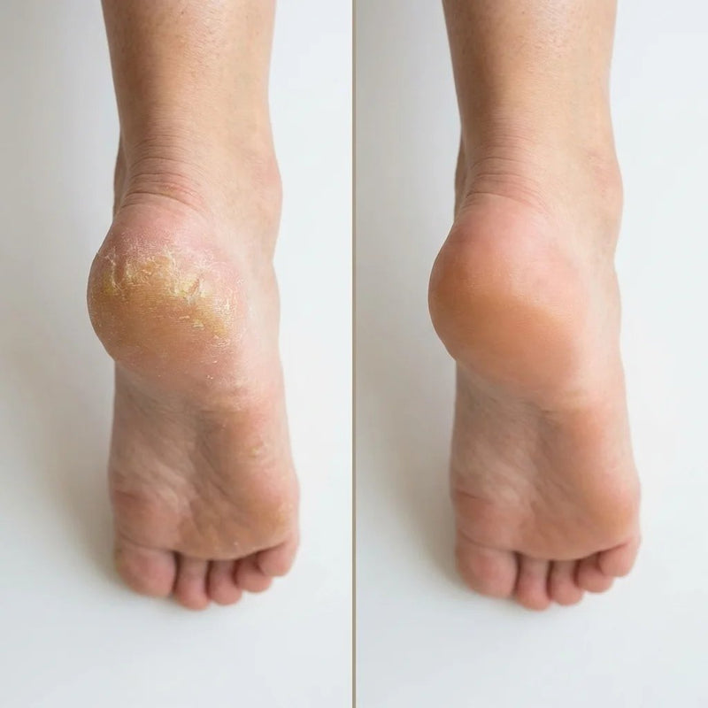 Comparacion del talon antes y despues del exfoliador