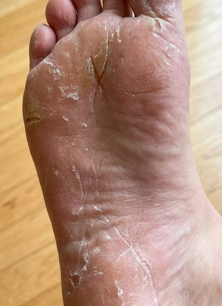 Comparativa de pies 3: antes y después: Antes