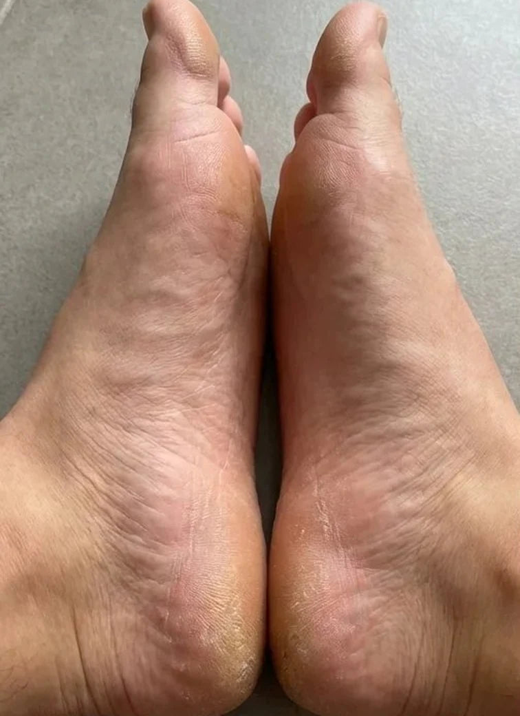 Comparativa de pies 5: antes y después: Antes