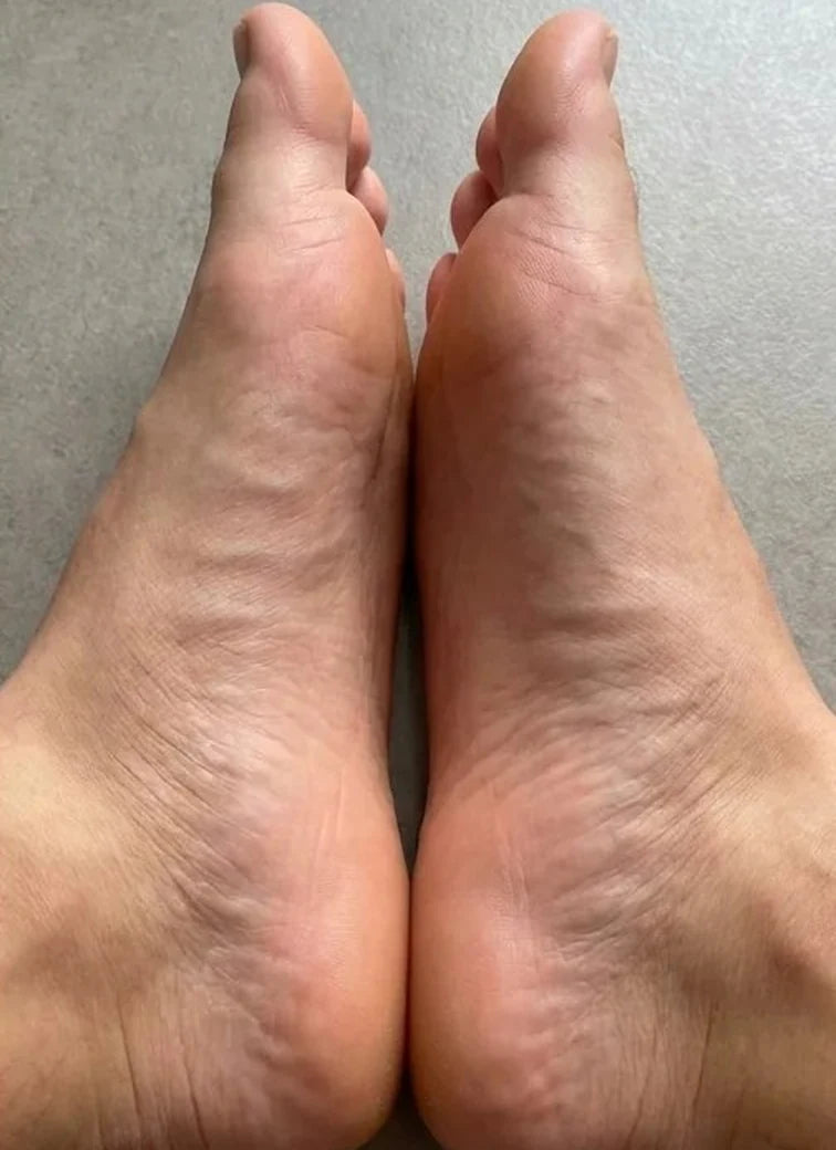 Comparativa de pies 5: antes y después: Después
